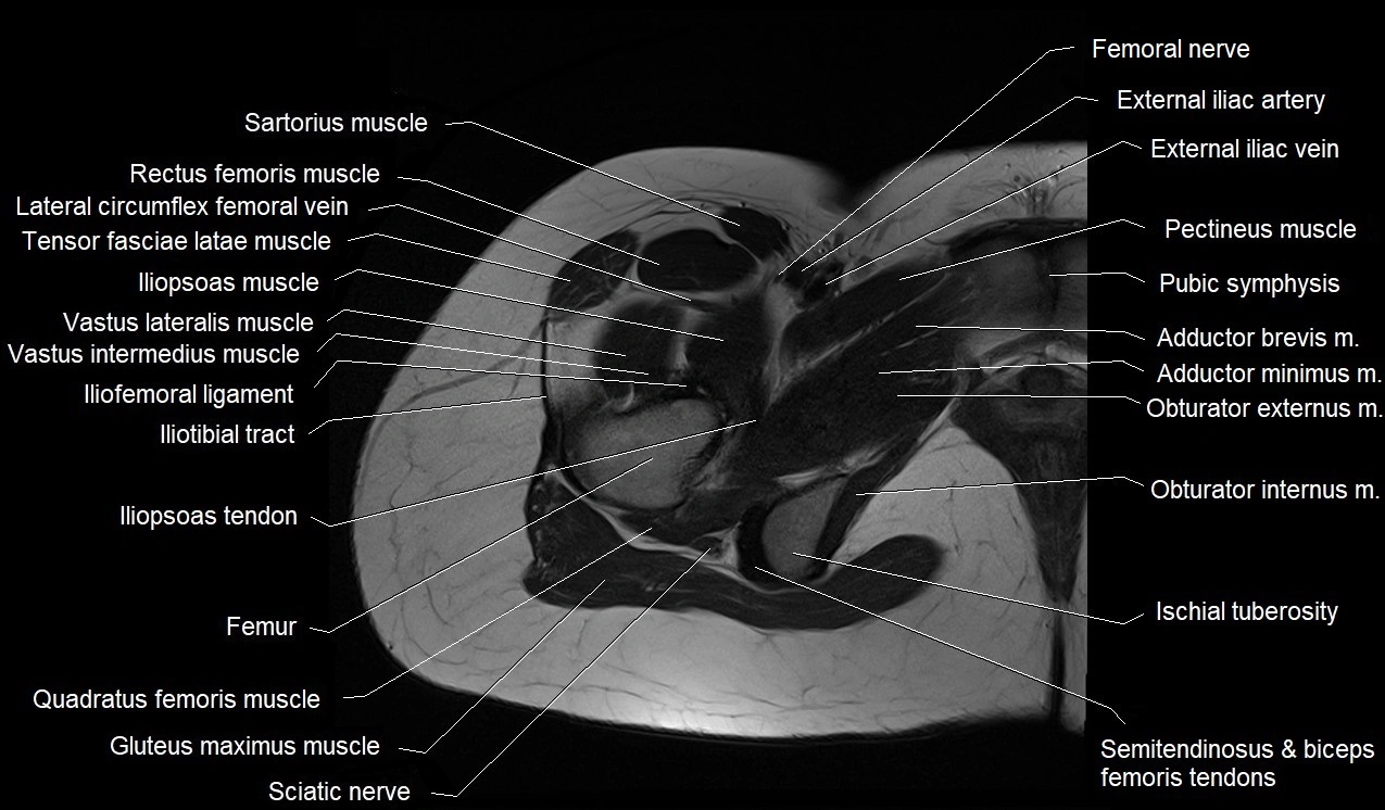MRI thigh cross sectional anatomy image 11.webp